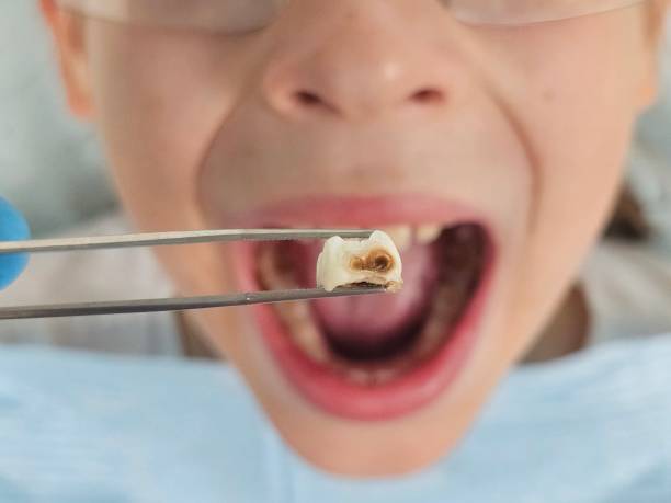 Best Emergency Wisdom Tooth Extraction in Clear Lake, WI